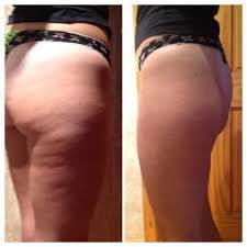BODY SPA FOR THIGHS OR BUTTOCKS TREATMENT