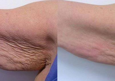 BODYSHAPING TREATMENTS FOR THE ARMS AREA