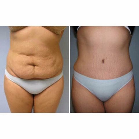 BODY SPA TREATMENTS FOR THE STOMACH